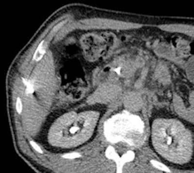 A 50-year-old man with history of pancreatic carcinoma underwent a CT-guided biopsy (above), which was nonconclusive (pathology result: normal liver tissue). Three weeks later, an MR-guided biopsy (below) was performed, and the biopsy revealed a cavernous hemangioma. Images courtesy of Dr. Rüdiger Hoffmann.