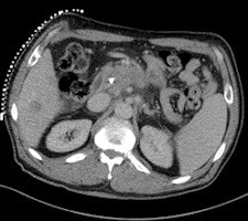 50-year-old man with history of pancreatic carcinoma underwent a CT-guided biopsy
