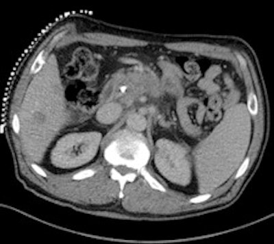 50-year-old man with history of pancreatic carcinoma underwent a CT-guided biopsy