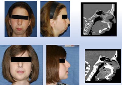Girl with severe mandibular hypoplasia benefited from the surgeon's ability to work with a precise model