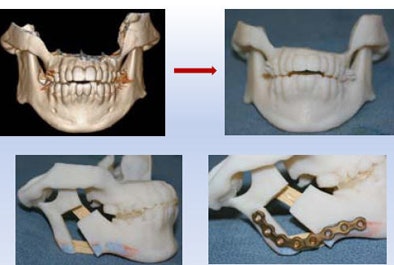 2011 10 11 14 46 44 783 Sosna mandibular hypoplasia bottom