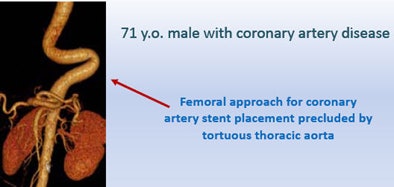 Treatment of a 71-year-old man with coronary artery disease was complicated by the patient's tortuous thoracic aorta