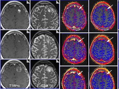 Multiparametric MRI was used to evaluate brain glioma response to bevacizumab therapy