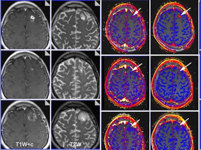 Multiparametric MRI was used to evaluate brain glioma response to bevacizumab therapy