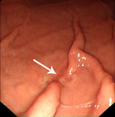 Above: Axial CT image shows questionable thickening and enhancement of inner mucosal layer (arrow). Bottom left: Virtual gastroscopic image clearly shows ulcerative lesion with abrupt termination of folds at the same location as axial CT image. Bottom right: Conventional gastroscopic image reveals a malignant ulcer with abrupt termination of gastric folds. This lesion was diagnosed as early gastric cancer on biopsy. Images courtesy of Dr. Jin Woong Kim and Dr. Sang Soo Shin.