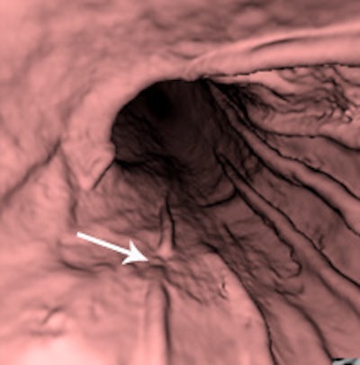 gastroscopic image clearly shows ulcerative lesion with abrupt termination of folds at the same location as axial CT image