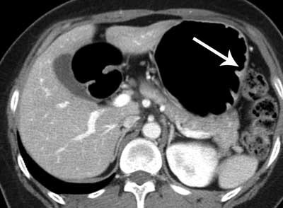 Axial CT image shows questionable thickening and enhancement of inner mucosal layer