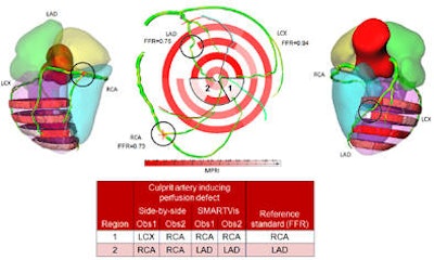On ICA, suspected stenoses (30%) were visually detected in the three main arteries (LAD, LCX, and RCA). Based on the FFR measurement, only the stenoses in the LAD and RCA were significant (FFR LAD = 0:75, FFR RCA = 0:73) while the stenosis in the LCX was not considered to be significant (FFR LCX = 0:94). During the analysis, reader one assigned a perfusion defect in the apical inferior and inferoseptal wall to the RCA (resp. LAD) and in the inferolateral wall to the LCX (resp. RCA) using the conventional (resp. SMARTVis) tool. This patient has a right-dominant system, thus the RCA is feeding a larger area. In that case also, the coronary overlay and perfusion territory map helped him to correct his diagnosis. Similarly, reader two misclassified the perfusion defect in the inferoseptal wall to the RCA, missing the significant stenosis in the LAD with the conventional tool, but reaching a correct diagnosis using the SMARTVis tool.
