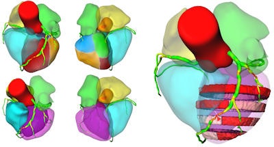 Comprehensive visualizations proposed in the SMARTVis tool. Left: 3D model of the heart and coronary artery tree extracted from coronary CTA; arteries are color-coded with the degree of stenosis. Also, patient-specific perfusion territories are shown on the left ventricle (left anterior descending [LAD] in red, left circumflex [LCX] in blue, marginal obtuse [MO] in yellow, and right coronary artery [RCA] in green). Right: 3D model of the heart with perfusion information integrated. All images courtesy of Hortense Kirişli, PhD.