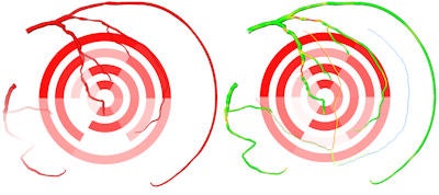 Left: 2D perfusion bull's-eye plot (BEP) with coronary tree projected on top; the more transparent the artery, the further it is from the epicardium. Right: 2D perfusion BEP with coronary tree and coronary perfusion territories projected on top; arteries are color-coded with the degree of stenosis. The spheres next to the 2D BEP indicate the position of connection with the right ventricle.