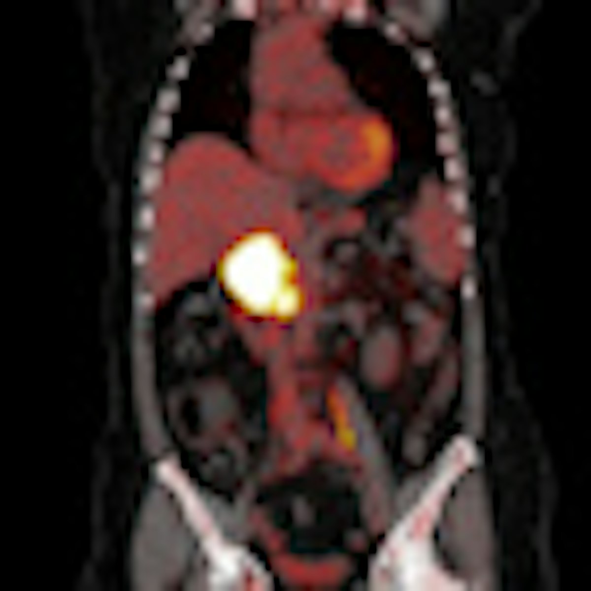 EANM: PET/CT proves value in detecting second tumors | AuntMinnieEurope
