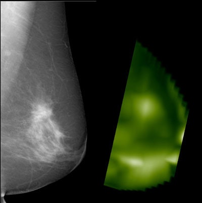 X-ray mammography (mediolateral-oblique projection) and near-infrared image (CT laser mammography) of a 60-year-old patient with an invasive ductal carcinoma in the left breast. Due to the enhanced hemoglobin concentration, the tumor is shown at high signal on optical mammography compared with the surrounding tissue. Image courtesy of Dr. Alexander Poellinger.