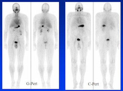 The impending shutdown of the Chalk River reactor in Canada has initiated research into alternative methods of production of technetium-99m, particularly using small medical cyclotrons. These images are the first GMP/GCP images of biodistribution of Tc-99m pertechnetate made on a cyclotron (C-Pert) compared with generator produced Tc-99m pertechnetate (G-Pert). This study is a collaboration among the University of Alberta, the University of Sherbrooke, and ACSI. All images courtesy of Dr. Sandy McEwan.