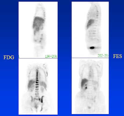 FDG and FES images in a patient with breast cancer metastatic to bone. The FES image shows heterogeneity of receptor expression at sites of bone metastases defined by FDG. This suggests the possibility of using FES as a means of stratifying patients for most appropriate treatment.