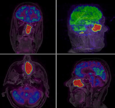 B-cell lymphoma of the left sinus with no metastatic disease. PET/MR images are shown in all three imaging planes for a clear picture of pathology in a very critical nasal cavity area. Ingenuity TF PET/MR system was used. All images and chart courtesy of Philips Healthcare.