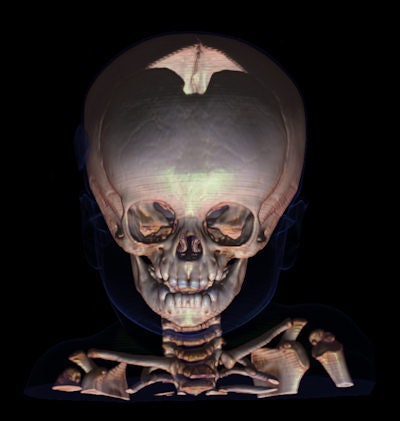Above: This child was found dead in his bed, and postmortem CT and MRI examinations were carried out a day after time of death.