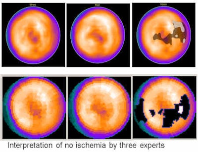 CAD can assist in the interpretation of myocardial perfusion scintigrams. The top row images were done by Exini, and no ischemia was found. The bottom row images were done by Perfex. The findings were there were four contiguous count deficits in the myocardial perfusion distribution. Count deficits not reported below were deemed to be statistically insignificant at the specified sensitivity and specificity. The second area, which probably is diseased, is mainly located in the lateral wall. There is moderate evidence of reversibility. Source: Dr. Lena Johansson, Dr. Milan Lomsky, Dr. Jens Marving, Dr. Sven-Eric Svensson, Dr. Lars Edenbrandt, P199, EANM congress, 15-19 October 2011.