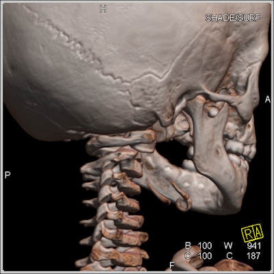 Les autopsies virtuelles peuvent jouer un rôle lorsque l'équipe médico-légale soupçonne un cas de maltraitance d'enfant. Sur cette image, le scanner crânien post mortem avec rendu volumique suggère une subluxation atlanto-axiale rotatoire. Veuillez remarquer la position de la masse latérale droite de la première vertèbre cervicale comparée à la colonne de masses latérales droites des vertèbres inférieures. Il s'agit d'une découverte non accidentelle dans plusieurs scanners post mortem. Images fournies avec l'aimable autorisation du docteur Anders Persson, PhD, Centre pour la science de l'imagerie médicale et la visualisation, Université Linköpings, Suède.