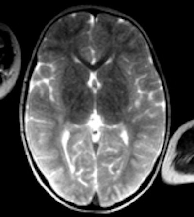 A gauche: scanner conventionnel, épaisseur de coupe de 5mm. A cause de la décomposition, il peut être difficile de différencier la matière grise et la substance blanche, même un jour après l'heure du décès. Au milieu: image 3D, rendu volumique. Cette technique permet dans certains cas de mieux maîtriser les changements post mortem dans l'atténuation cérébrale, mais il reste difficile de différencier les divers tissus cérébraux. Aucune pathologie n'a pu être détectée. A droite: l'IRM (séquence T2) offre une meilleure différentiation entre les divers tissus cérébraux. Si le corps a une température d'à peu près 10° C, les images IRM peuvent être assez bruyantes. Après le scanner et l'IRM, le syndrome de l'enfant battu a été exclu.