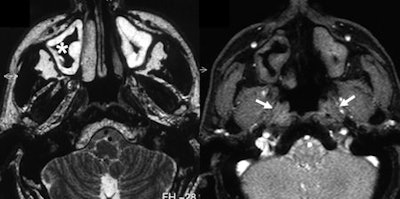 T2-weighting shows sinusitis with swelling of the mucosa. Real-time imaging demonstrates that both eustachian tubes do not open during Valsalva maneuver (right image, arrows).