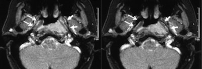 Real-time imaging showed regular opening of the right eustachian tube during Valsalva maneuver (open arrows, right image: neutral position; left image: Valsalva maneuver). The left tube opens only in the anterior part but not in the middle part, due to compression from the tumor (arrows).