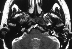 The T2-weighted image shows carcinoma in the left recess of RosenmĂĽller (arrows). The eustachian tube is not infiltrated, but slightly displaced laterally. All images courtesy of Dr. Gabriele Krombach.
