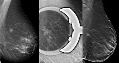 To identify suspicious areas -- for instance, to evaluate microcalcifications -- digital spot compression view is often used as a complement to mammography. Left: Mammography shows a suspicious area first. Center: The same lesion is also visible on digital spot compression. Right: Tomosynthesis gives a better conspicuity of the lesion. All images courtesy of Dr. Alberto Tagliafico.