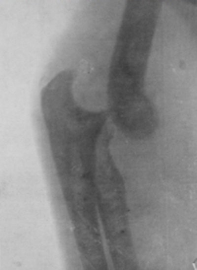 Early radiograph obtained at the Royal Free Hospital in London.