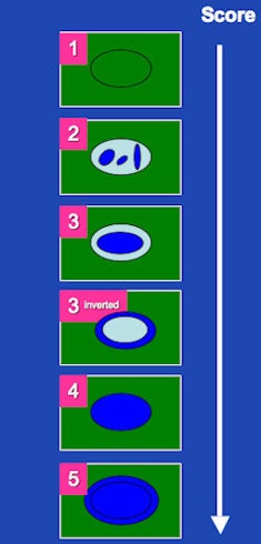 Color-coded elastographic score (SC1 to 5) suggested by Itoh et al for breast disease and modified by Goddi et al for testicular lesion assessment. 1 indicates strain for entire lesion. 2 indicates strain in most of the solid lesion with some areas of no strain. 3 indicates strain at the periphery of the solid lesion, with no strain at the center. 3-inverted indicates strain at the center of the solid lesion, with no strain at the periphery of the lesion. 4 indicates no strain in the entire lesion. 5 indicates no strain in the entire solid lesion and surrounding area. If scored between 1 and 3, lesion would be benign; if scored 3-inverted, lesion would be considered suspect for a Leydig tumor; if scored 4 or 5, lesion would be considered malignant.