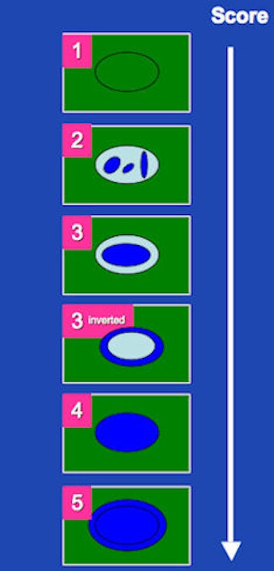 Color-coded elastographic score (SC1 to 5) suggested by Itoh et al for breast disease and modified by Goddi et al for testicular lesion assessment. 1 indicates strain for entire lesion. 2 indicates strain in most of the solid lesion with some areas of no strain. 3 indicates strain at the periphery of the solid lesion, with no strain at the center. 3-inverted indicates strain at the center of the solid lesion, with no strain at the periphery of the lesion. 4 indicates no strain in the entire lesion. 5 indicates no strain in the entire solid lesion and surrounding area. If scored between 1 and 3, lesion would be benign; if scored 3-inverted, lesion would be considered suspect for a Leydig tumor; if scored 4 or 5, lesion would be considered malignant.