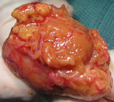 Top left: Grayscale ultrasound image of the testes showing a large isoechoic nodule (40 x 20 mm) compared with the testicular tissue (arrows). Top right: Color Doppler showing peripheral and central vascularization of the nodule, suggesting a malignant lesion. Bottom left: RTE of the nodule showing a large central strain area (mainly an intermediate elastic pattern displayed in green) (*) surrounded by a no-strain rim (the peripheral part of the lesion is blue) (arrows). This pattern, that the researchers suggested calling 'score 3-inverted' (the opposite of the known color-coded score 3 reference of Itoh et al) seems to be related to the Leydig tumors. Bottom right: Gross specimen of the testicle. Histological diagnosis of the nodule was Leydig tumor, consisting of cells with abundant cytoplasm without interstitial fibrous stroma; the slow growth of the tumor induces sclerohyalinosis at the periphery. The tumor's macrostructure explains the RTE pattern.
