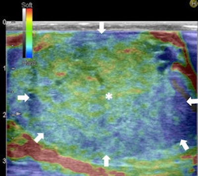 RTE of the nodule showing a large central strain area surrounded by a no-strain rim