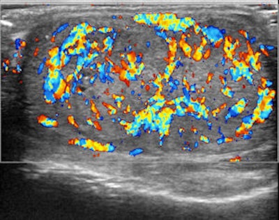 Color Doppler showing peripheral and central vascularization of the nodule suggesting a malignant lesion
