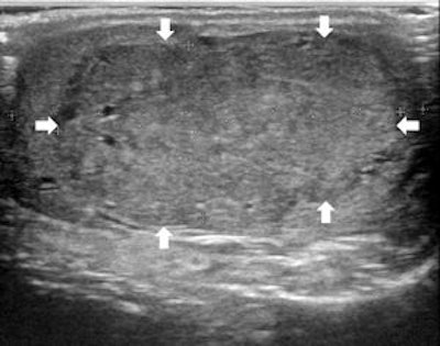Grayscale ultrasound image of the testes showing a large isoechoic nodule