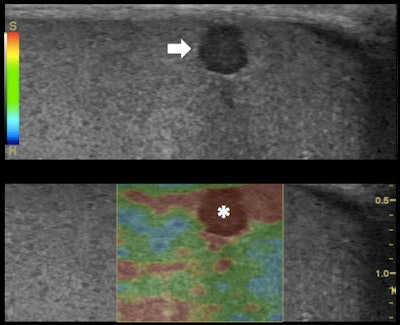 Top: Grayscale ultrasound longitudinal image of the testes: subcapsular 3-mm (in size) hypoechoic lesion (arrow). Bottom: RTE shows higher tissue displacement of the lesion (displayed in red) (*) compared with the testicular tissue (mainly displayed in green), suggesting a benign appearance: dense cyst. All images courtesy of Dr. Alfredo Goddi, SME-Diagnostica per Immagini Medical Center, Varese, Italy.