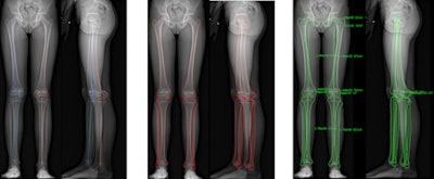 Above: From left to right, the calibration points, the contours, and the 3D measurements. Below: From left to right, 3D reconstructions views: frontal, lateral, back, up, and down. All images courtesy of Dr. Ramon Gheno.