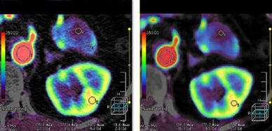 AIDR 3D (right) was applied to low-dose kidney perfusion protocol: 100 kV, 25 mAs. Image courtesy of Toshiba Medical Systems.