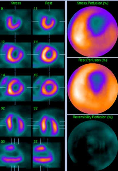 Myocardial perfusion scintigraphy performed with regadenoson.