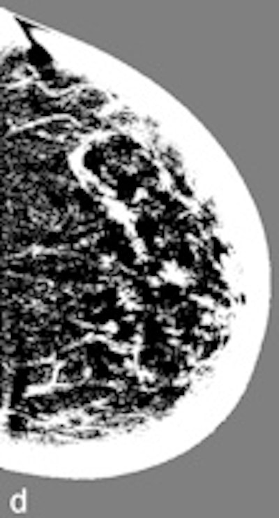Another example of a finding in a left-sided craniocaudal view that was reported clearly more often by radiologists when using premium view (PV). A: Tissue equalization (TE) processed image. B: PV processed image with the annotation. C: Similar to image above, the resulting image of subtracting TE from PV. D: The thresholded version of C.
