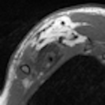 2011 11 23 10 52 49 261 2011 11 23 Mri Brachial Thumb