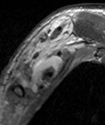 Young man who underwent a brachial plexus MRI examination following a motorcycle accident. A complex brachial plexus lesion is depicted. This case has been considered a true positive. All images courtesy of Dr. Alberto Tagliafico.