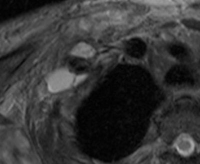 Brachial MRI