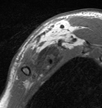 Brachial MRI