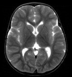 This child was found dead at home. To rule out the suspicion of battered child syndrome, post-mortem CT and MRI examinations were carried out two days after the time of death. Left: Conventional CT showed no signs of bleeding or other abnormal findings. In this image, it is almost impossible to differentiate between white and gray brain tissue. Center: Image postprocessed with volume-rendering 3D technique. It is easier to visualize post-mortem gray and white brain tissue. Right: Synthetic quantitative MRI examination. Excellent differentiation of the brain tissue can be achieved, regardless of the body temperature, even two days after time of death. All images courtesy of Dr. Anders Persson, PhD, Center for Medical Image Science and Visualization, Linköpings Universitet, Sweden.