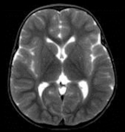 This child was found dead at home. To rule out the suspicion of battered child syndrome, post-mortem CT and MRI examinations were carried out two days after the time of death. Left: Conventional CT showed no signs of bleeding or other abnormal findings. In this image, it is almost impossible to differentiate between white and gray brain tissue. Center: Image postprocessed with volume-rendering 3D technique. It is easier to visualize post-mortem gray and white brain tissue. Right: Synthetic quantitative MRI examination. Excellent differentiation of the brain tissue can be achieved, regardless of the body temperature, even two days after time of death. All images courtesy of Dr. Anders Persson, PhD, Center for Medical Image Science and Visualization, Linköpings Universitet, Sweden.