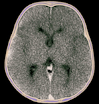 Image postprocessed with volume-rendering 3D technique