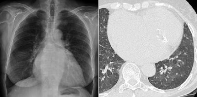 Chest Digital Tomosynthesis Versus Ct