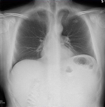 Digital tomosynthesis detected a left apical nodule in a 52-year-old male smoker. All images courtesy of Stephane Chauvie, PhD, and Dr. Maurizio Grosso.