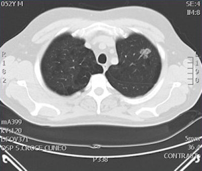 CT confirmed the nodule in the patient and consequently he underwent surgery, which confirmed the tumoral nature of the nodule.