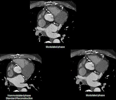 iDose cardiac. Dose modulation while still maintaining the noise index. This prospective cardiac scan was performed on a by-pass patient. Multiple areas of calcium were identified in the RCA and LAD.
